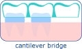 Dental bridge in Hungary