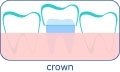 Dental crown in Hungary